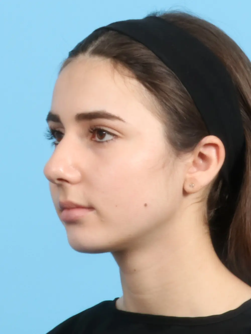 Rhinoplasty Patient Photo - Case 23366 - before view-2