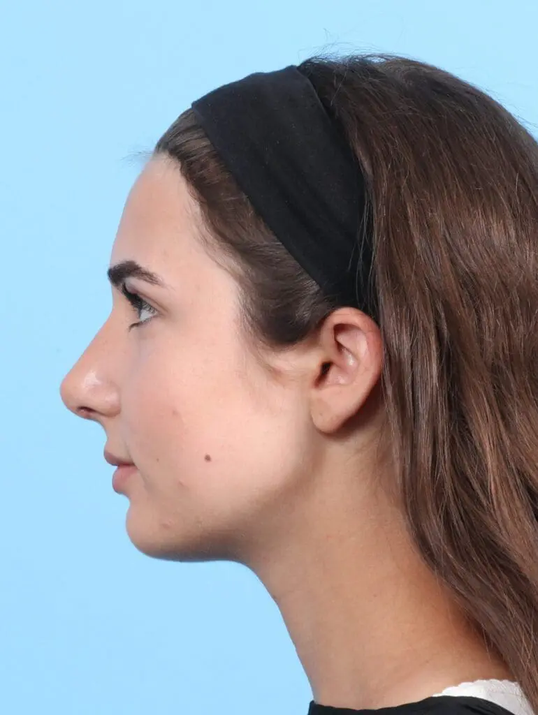 Rhinoplasty - Case 23366 - After