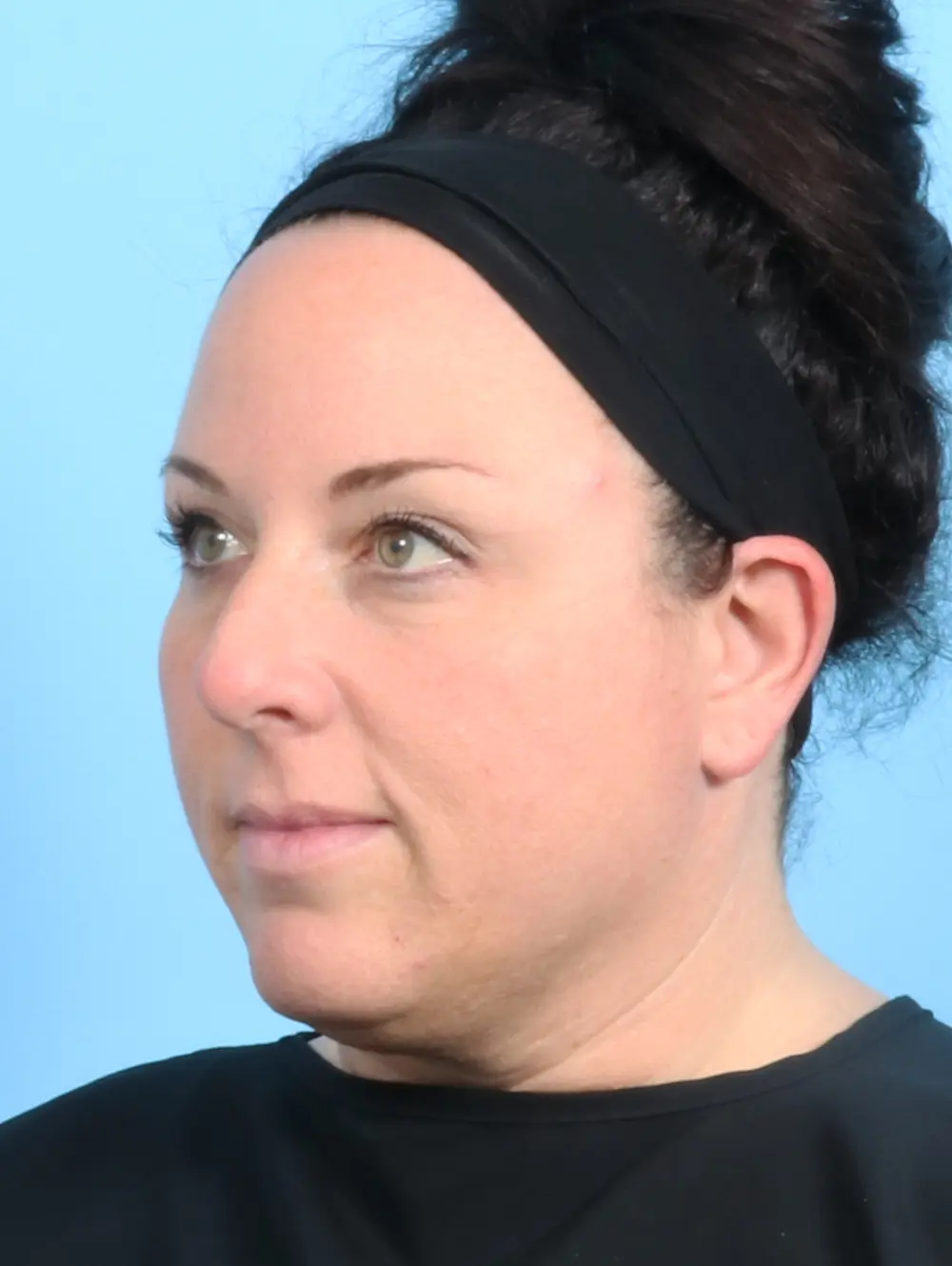 Rhinoplasty Patient Photo - Case 23390 - before view-1