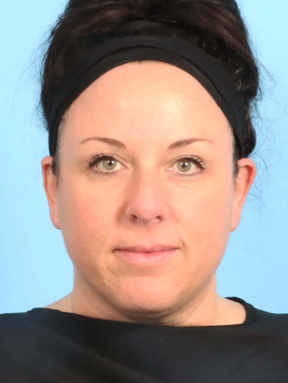 Rhinoplasty Patient Photo - Case 23390 - before view-2