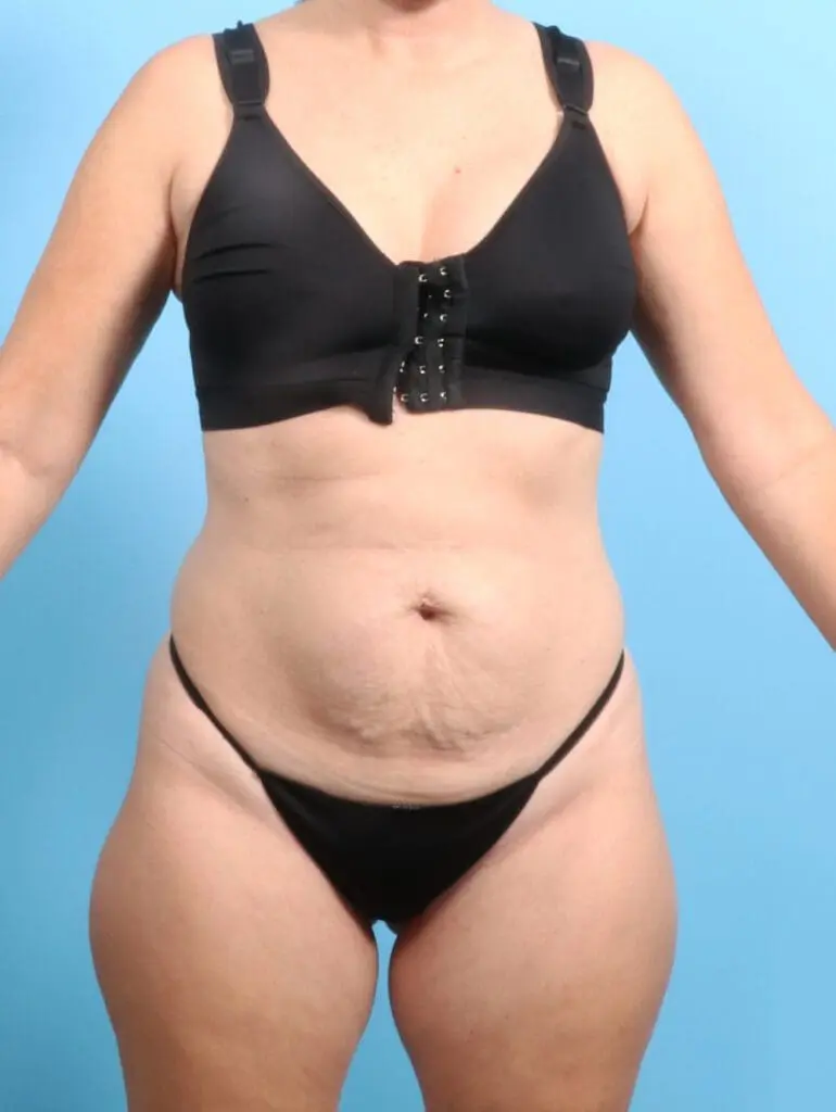 Tummy Tuck - Case 23398 - Before