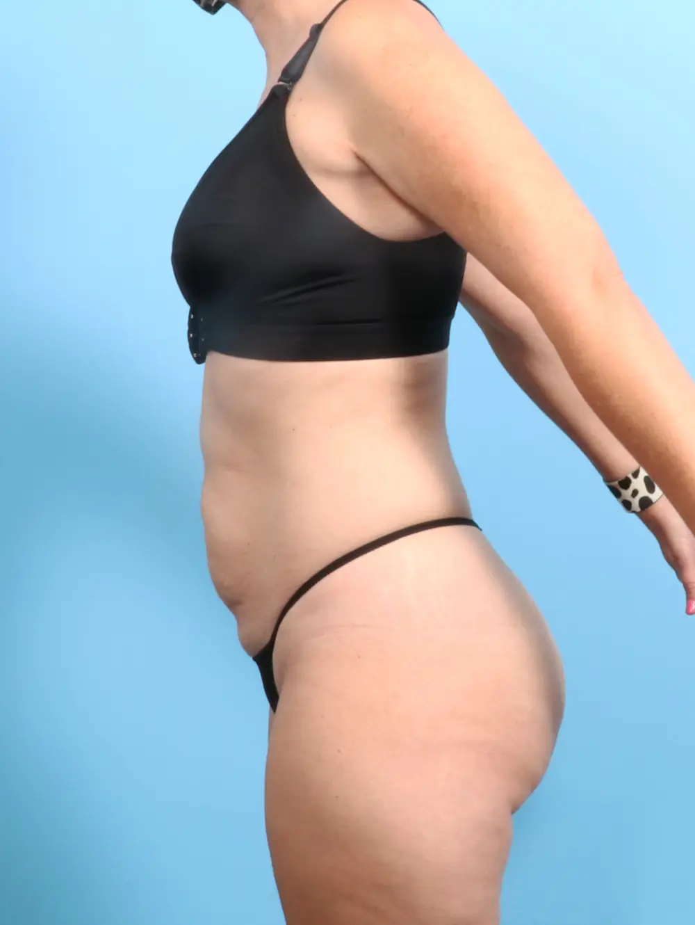 Tummy Tuck Patient Photo - Case 23398 - before view-2