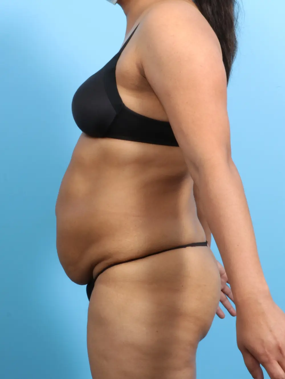 Tummy Tuck Patient Photo - Case 23406 - before view-2