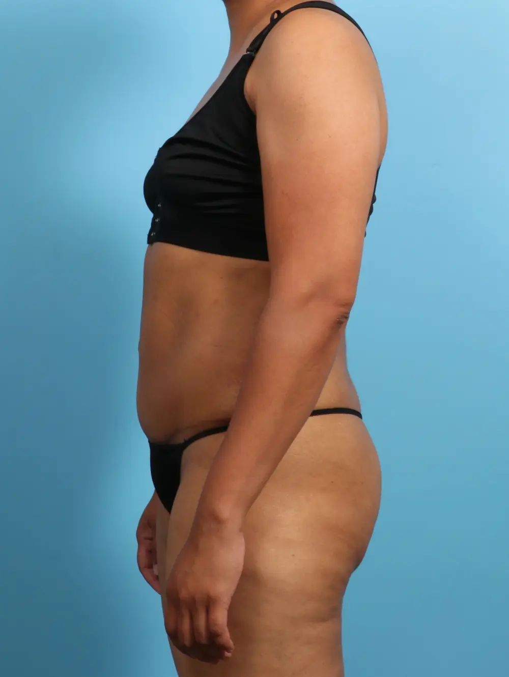 Tummy Tuck Patient Photo - Case 23406 - after view-2