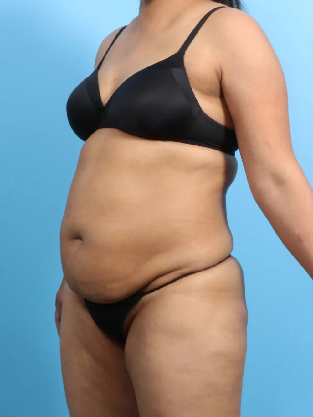 Tummy Tuck Patient Photo - Case 23406 - before view-1