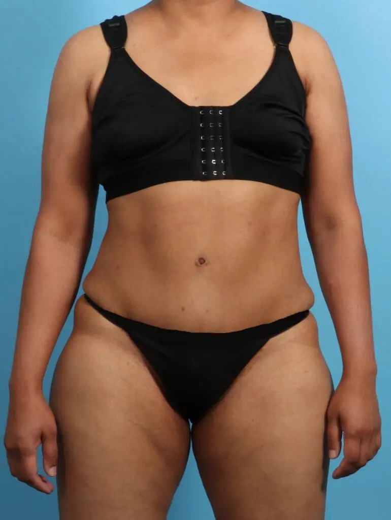 Tummy Tuck - Case 23406 - After