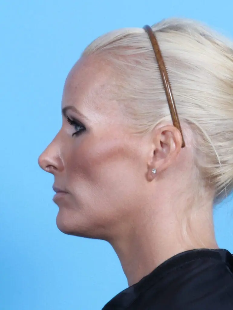 Rhinoplasty - Case 23425 - After