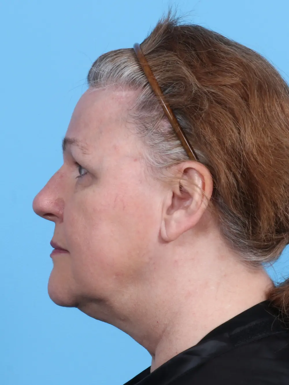 Brow Lift Patient Photo - Case 23450 - after view-2