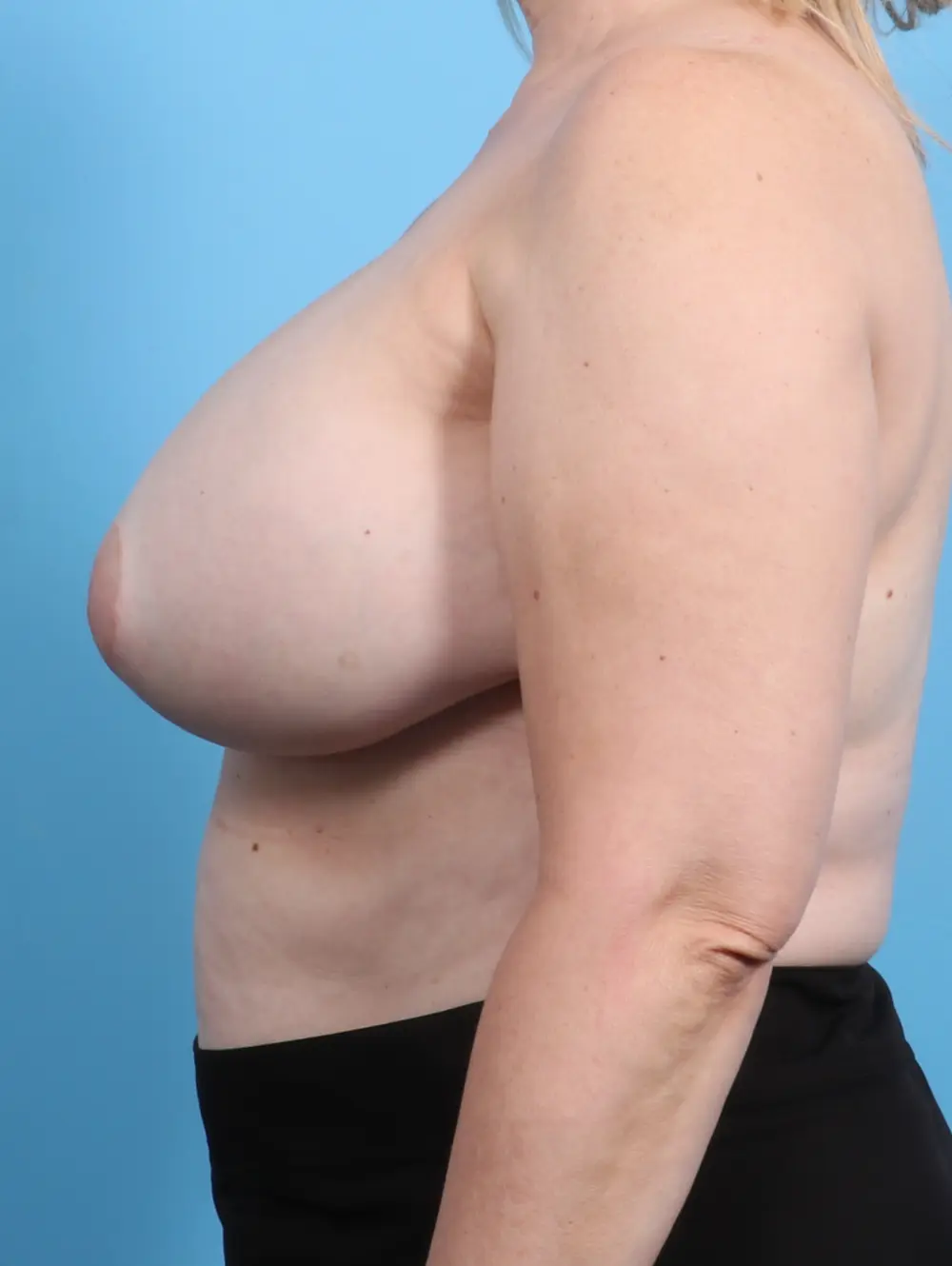 Breast Implant Revision Patient Photo - Case 23458 - after view-2