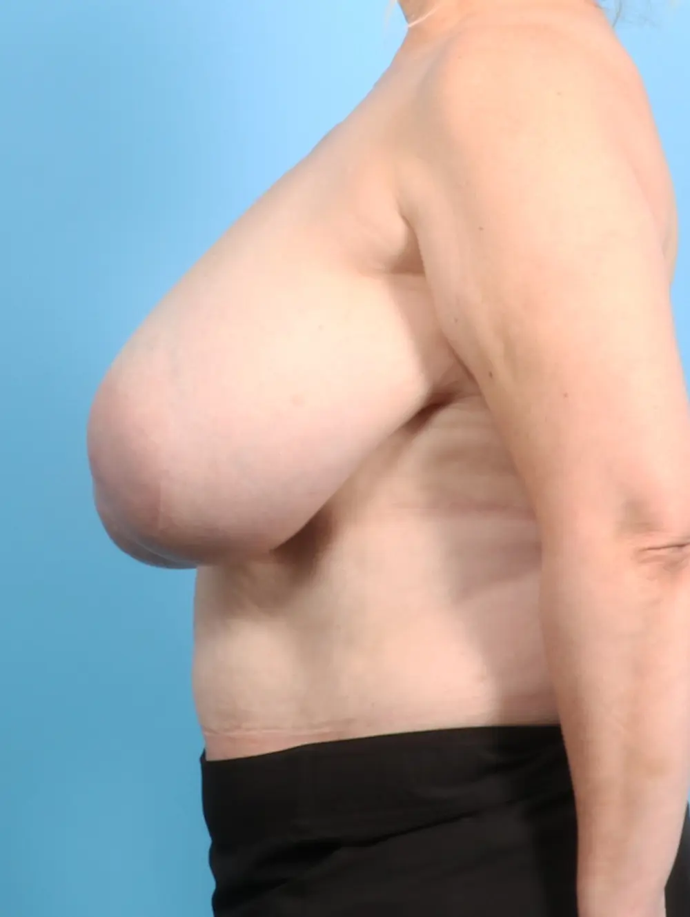 Breast Implant Revision Patient Photo - Case 23458 - before view-2