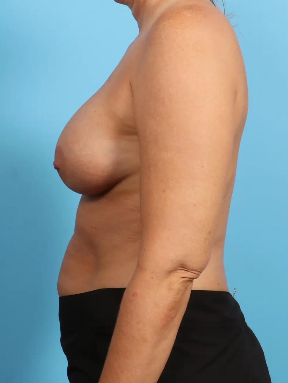 Breast Augmentation Patient Photo - Case 23474 - after view-2