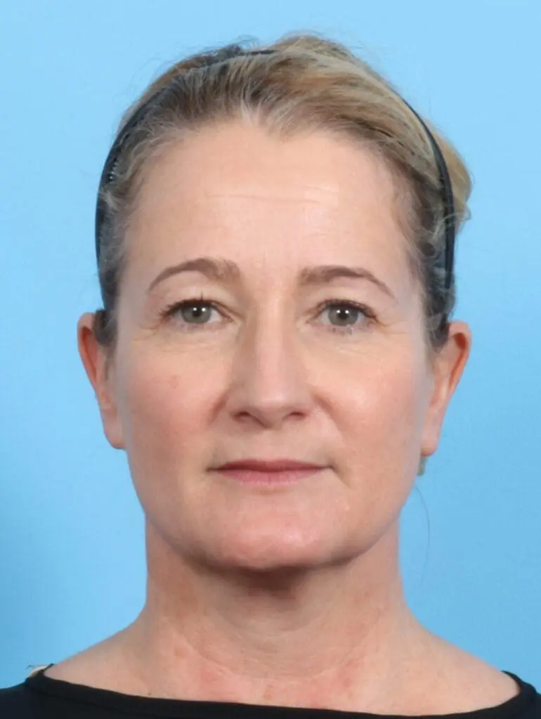 Brow Lift - Case 23498 - Before