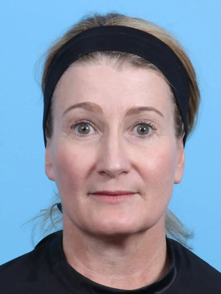 Brow Lift - Case 23498 - After