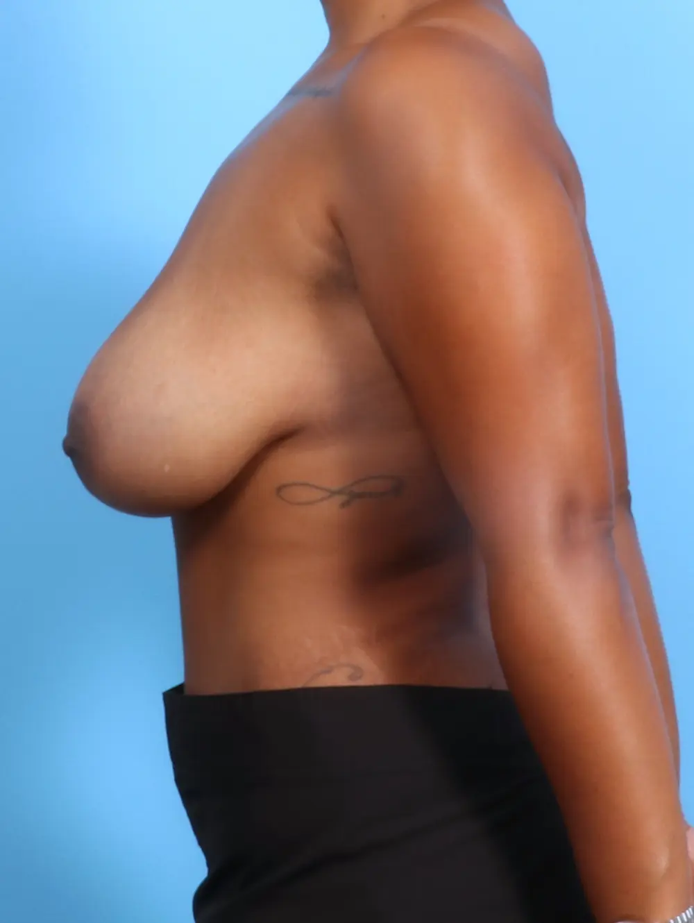 Breast Lift/Reduction with Implants Patient Photo - Case 23506 - before view-2