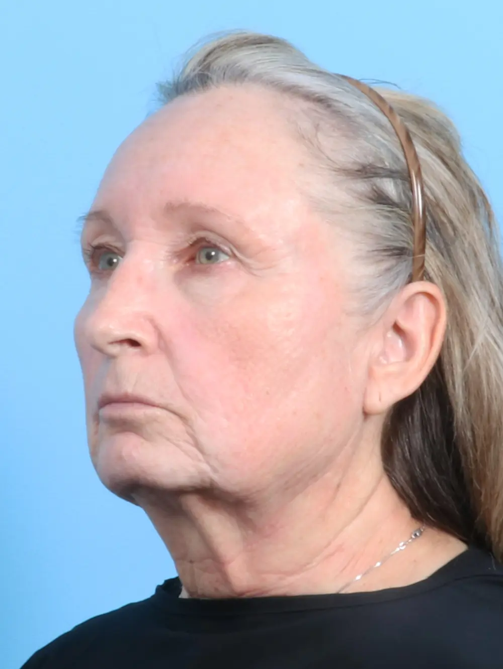 Fat Transfer Patient Photo - Case 23531 - before view-1