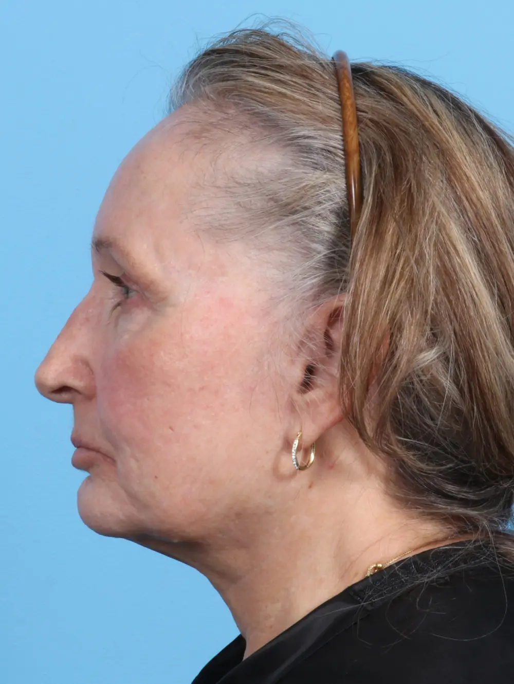 Fat Transfer Patient Photo - Case 23531 - after view-2