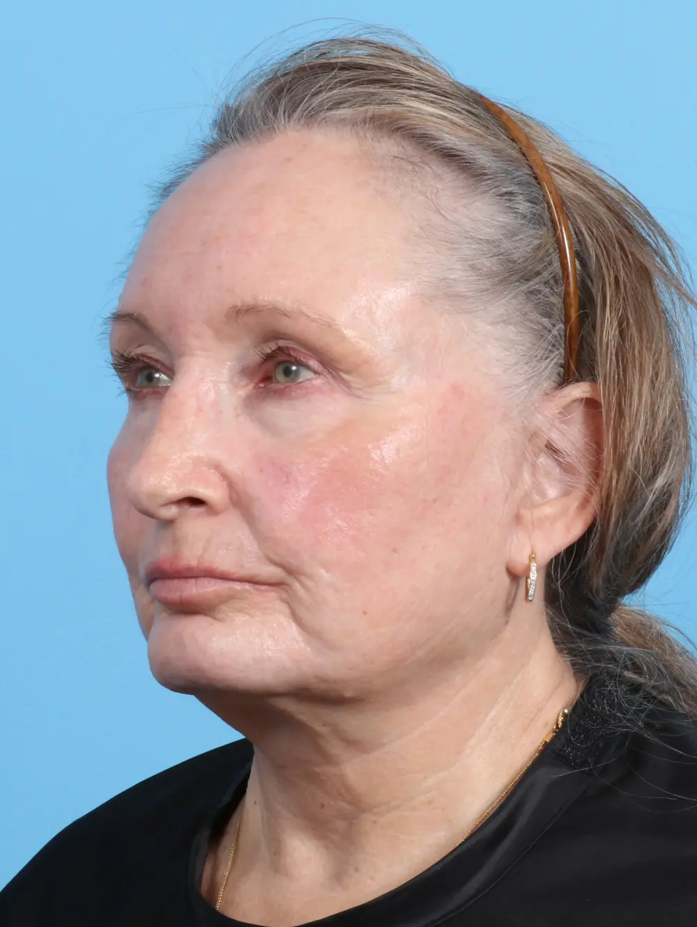 Fat Transfer Patient Photo - Case 23531 - after view-1