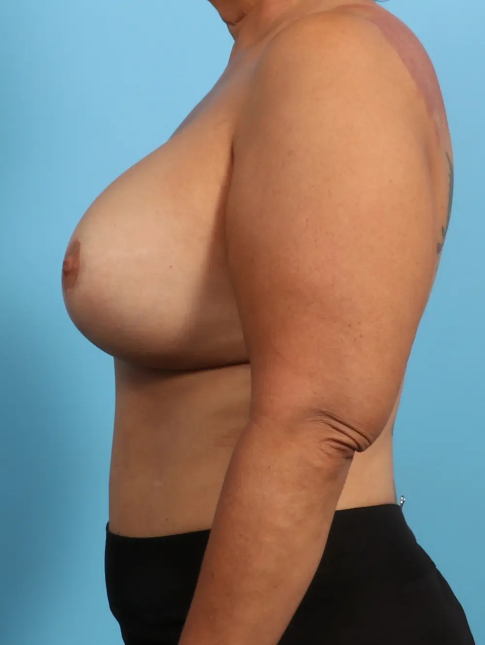 Breast Lift/Reduction with Implants Patient Photo - Case 23548 - after view-2