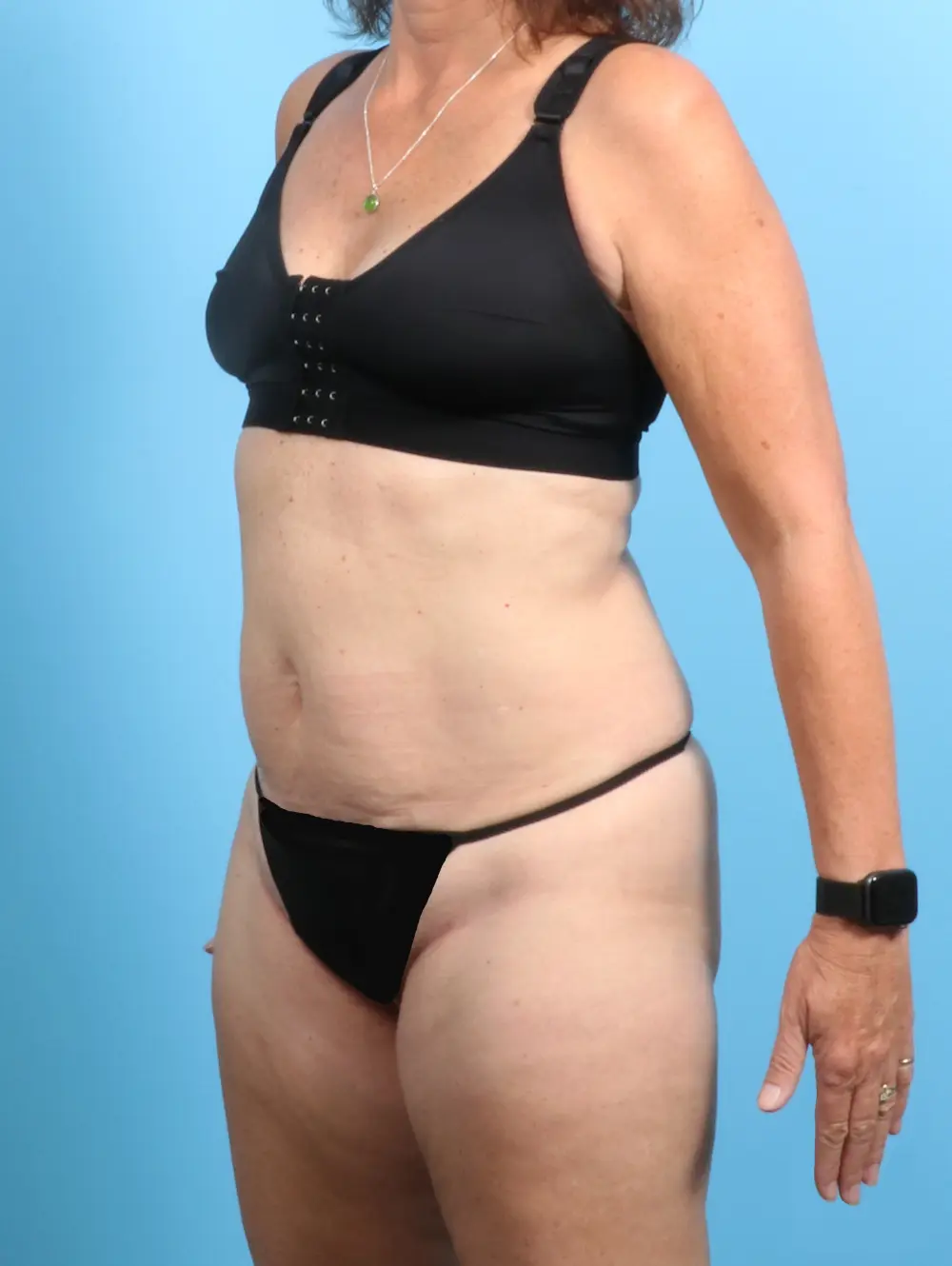 Tummy Tuck Patient Photo - Case 23556 - before view-1
