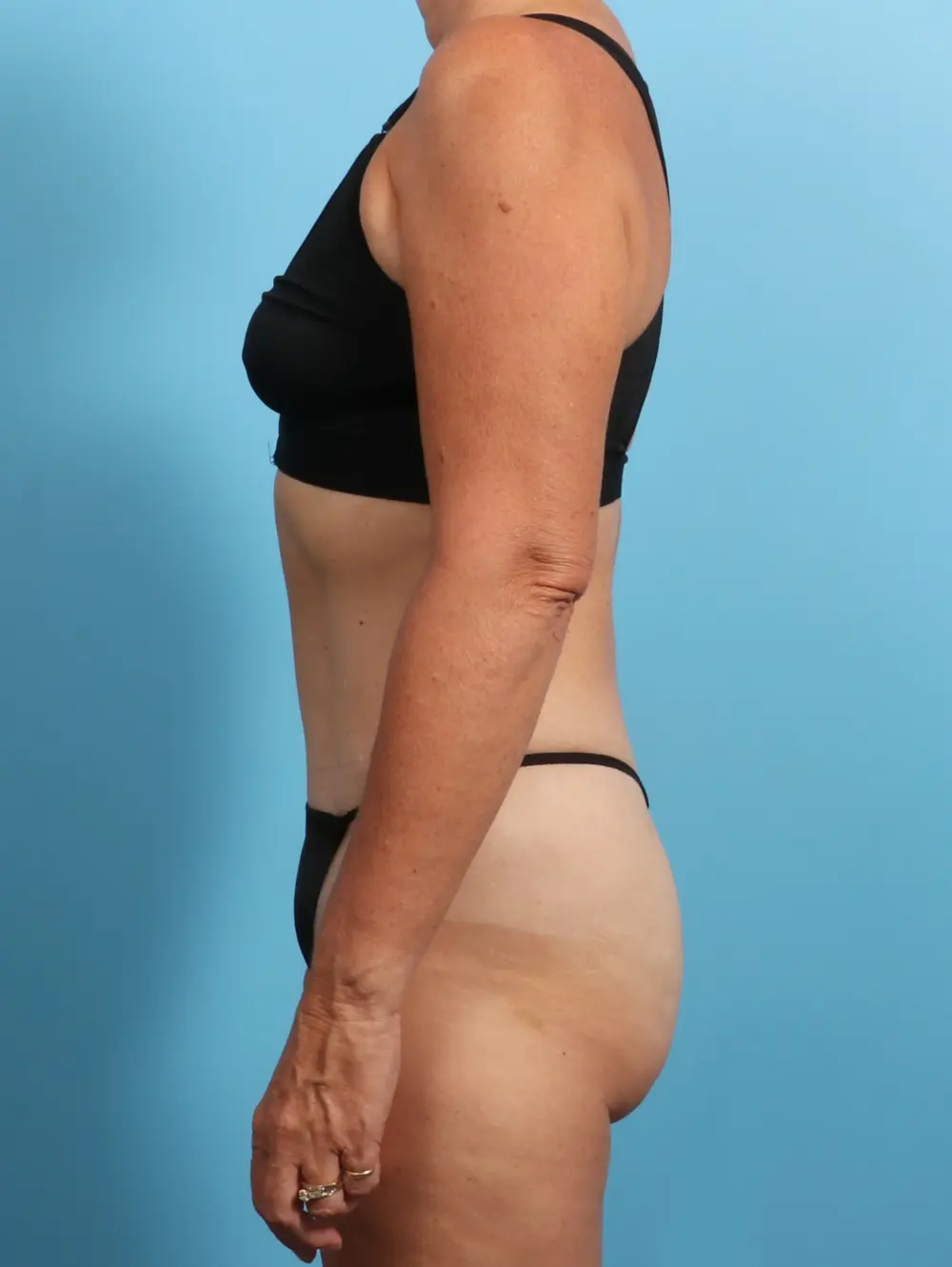 Tummy Tuck Patient Photo - Case 23556 - after view-2