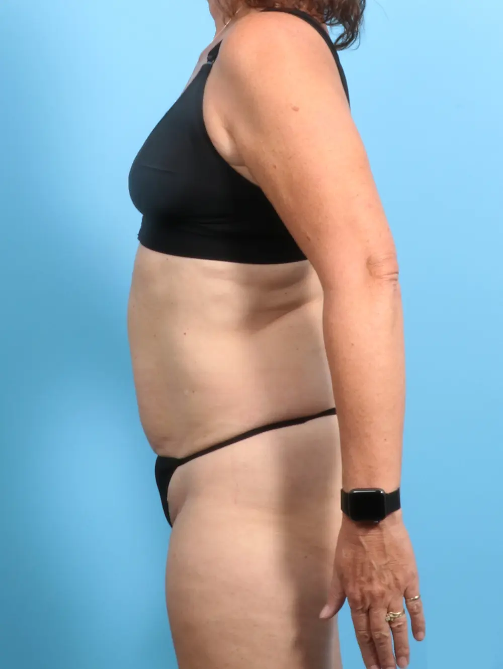Tummy Tuck Patient Photo - Case 23556 - before view-2