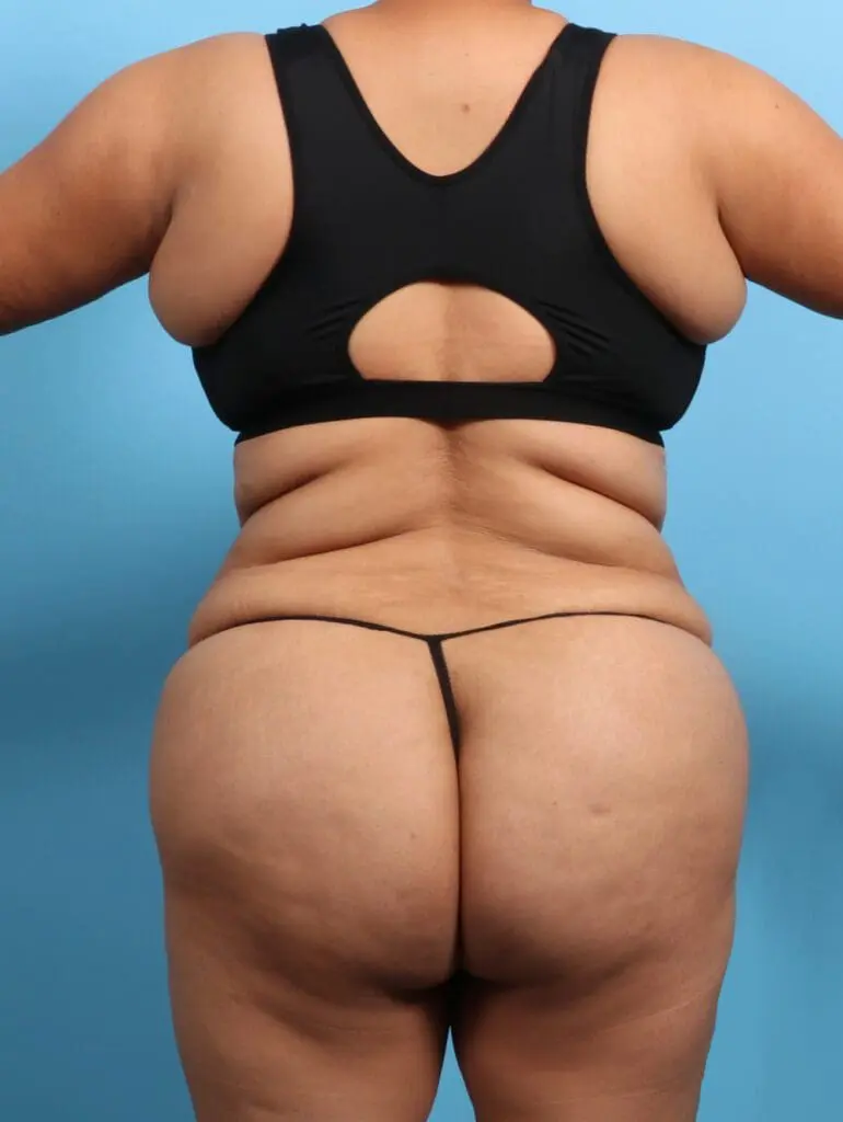 Brazilian Butt Lift - Case 23580 - After