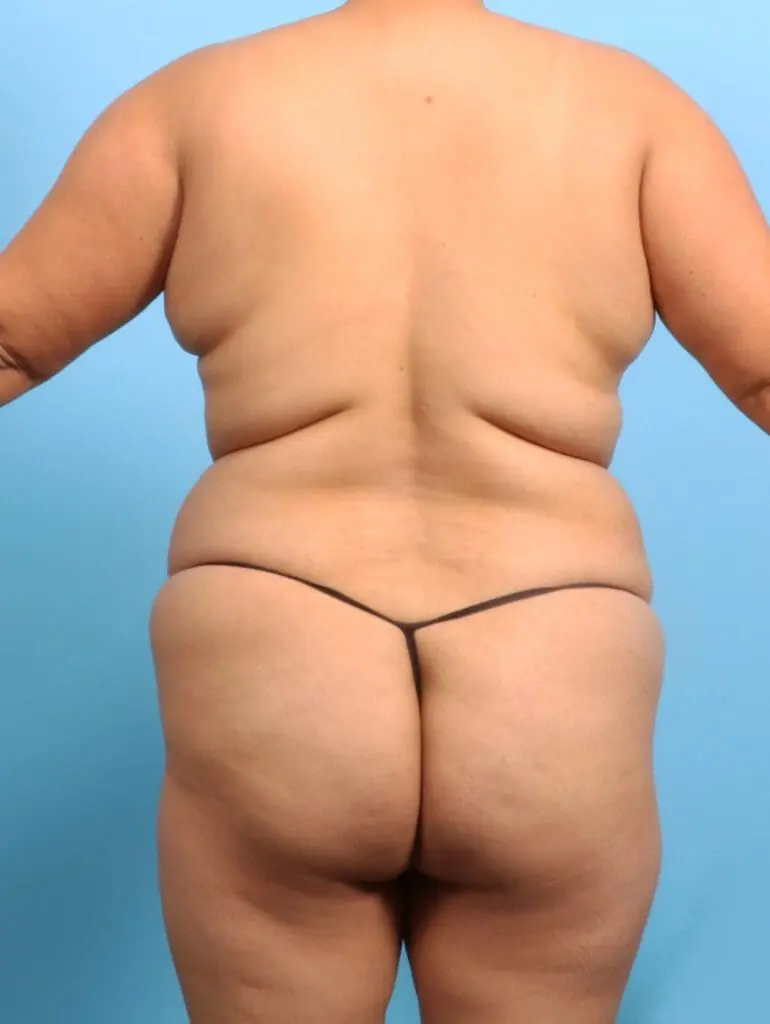 Brazilian Butt Lift - Case 23580 - Before