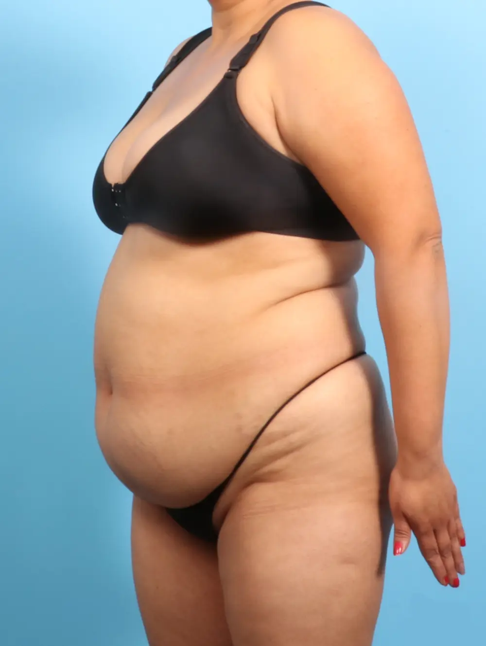 Tummy Tuck Patient Photo - Case 23584 - before view-1