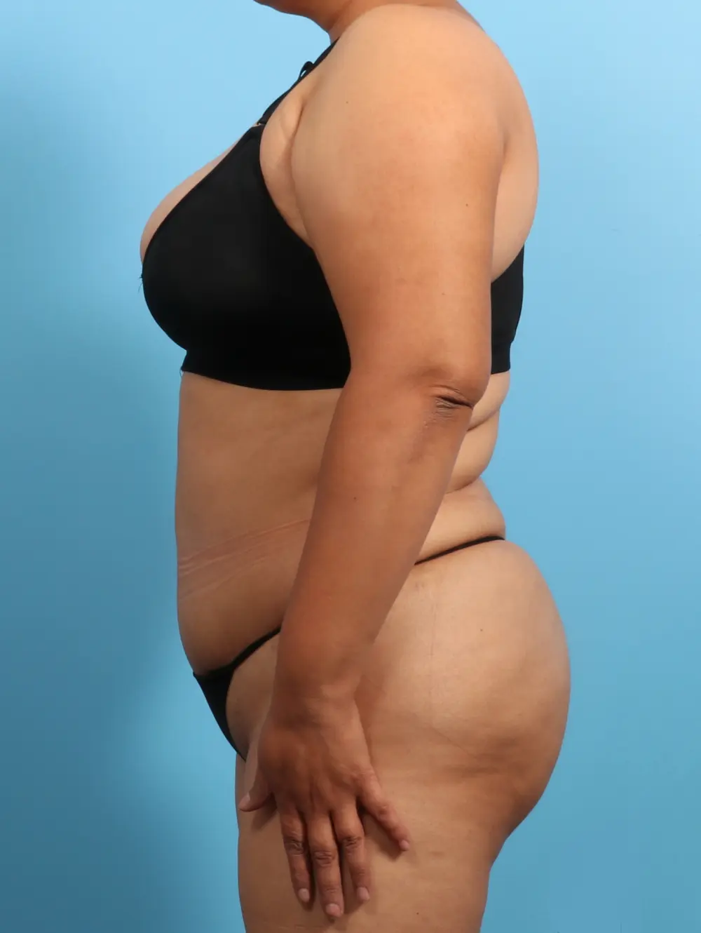 Tummy Tuck Patient Photo - Case 23584 - after view-2