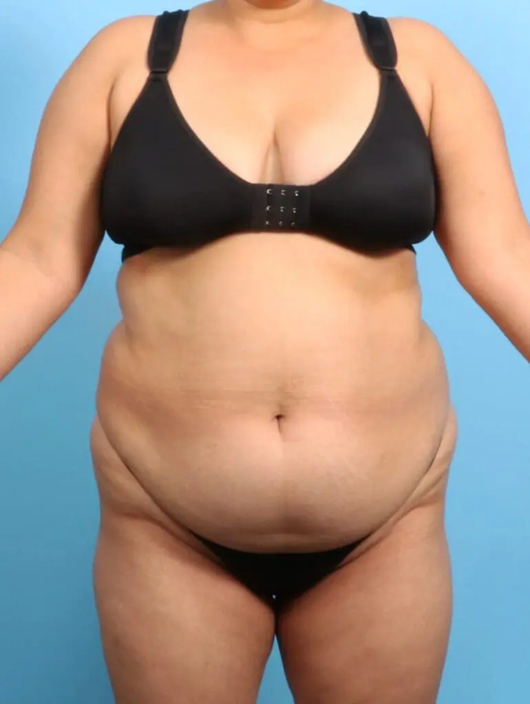 Tummy Tuck - Case 23584 - Before