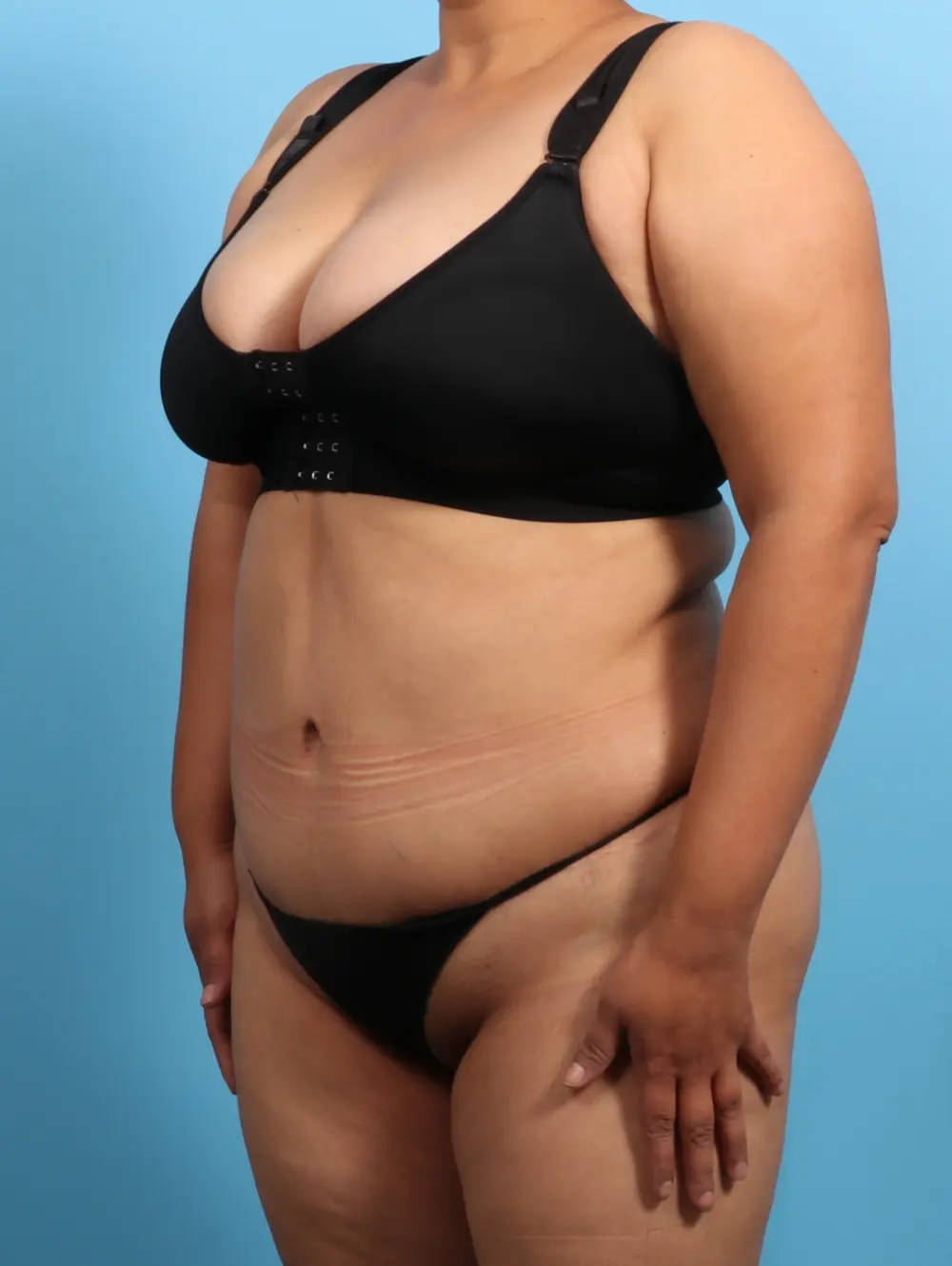 Tummy Tuck Patient Photo - Case 23584 - after view-1