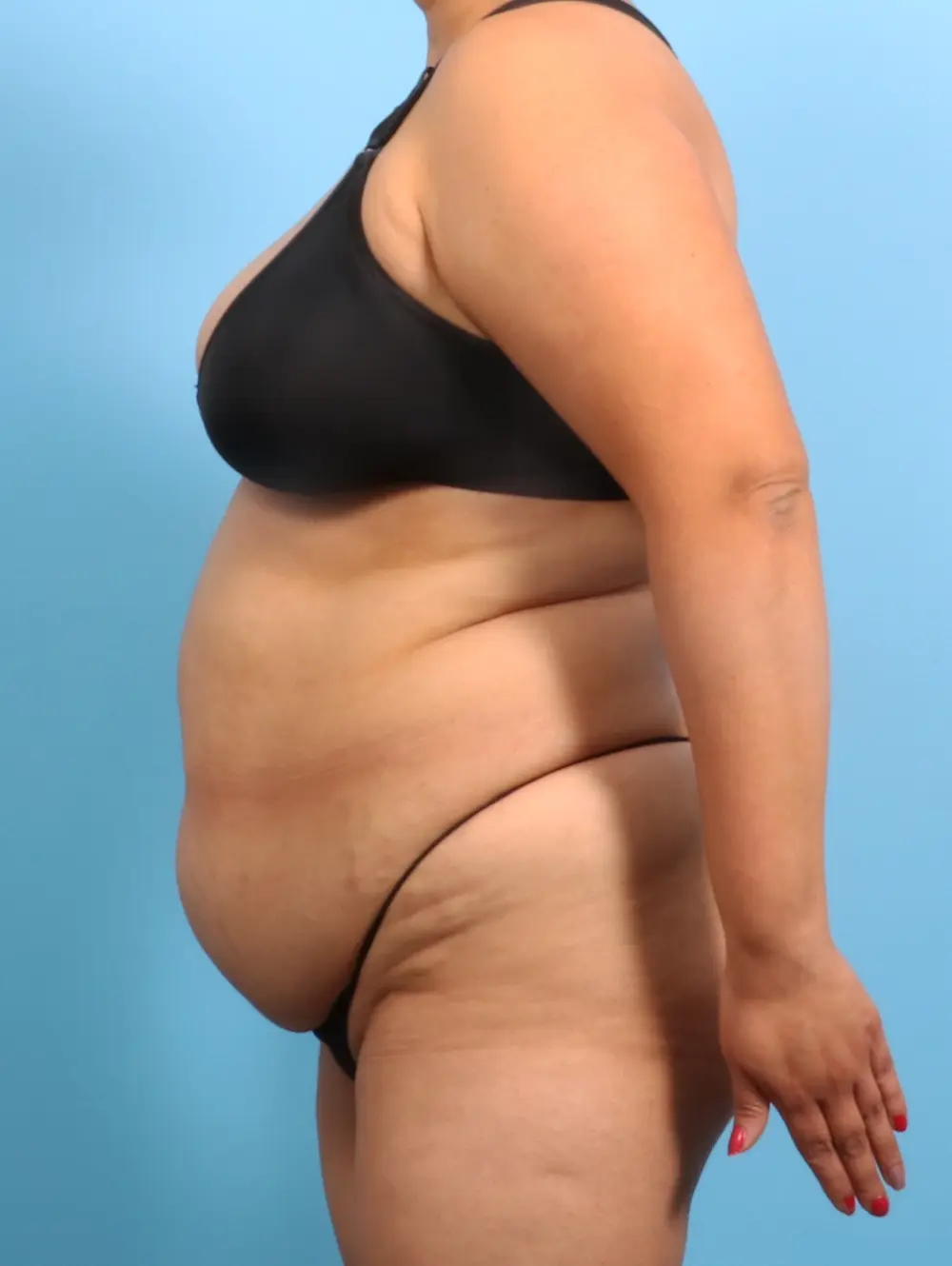 Tummy Tuck Patient Photo - Case 23584 - before view-2