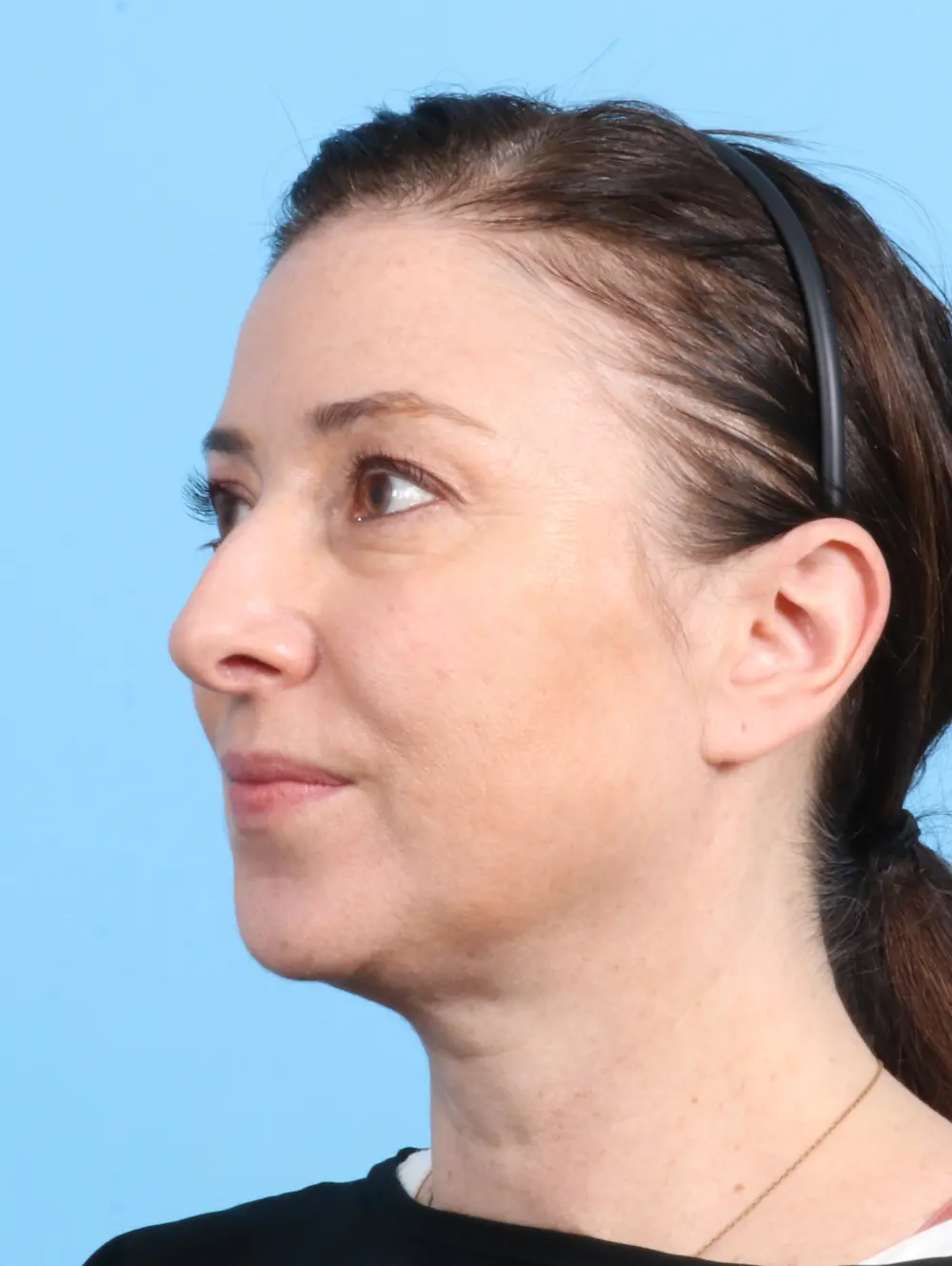 Rhinoplasty Patient Photo - Case 23600 - before view-2