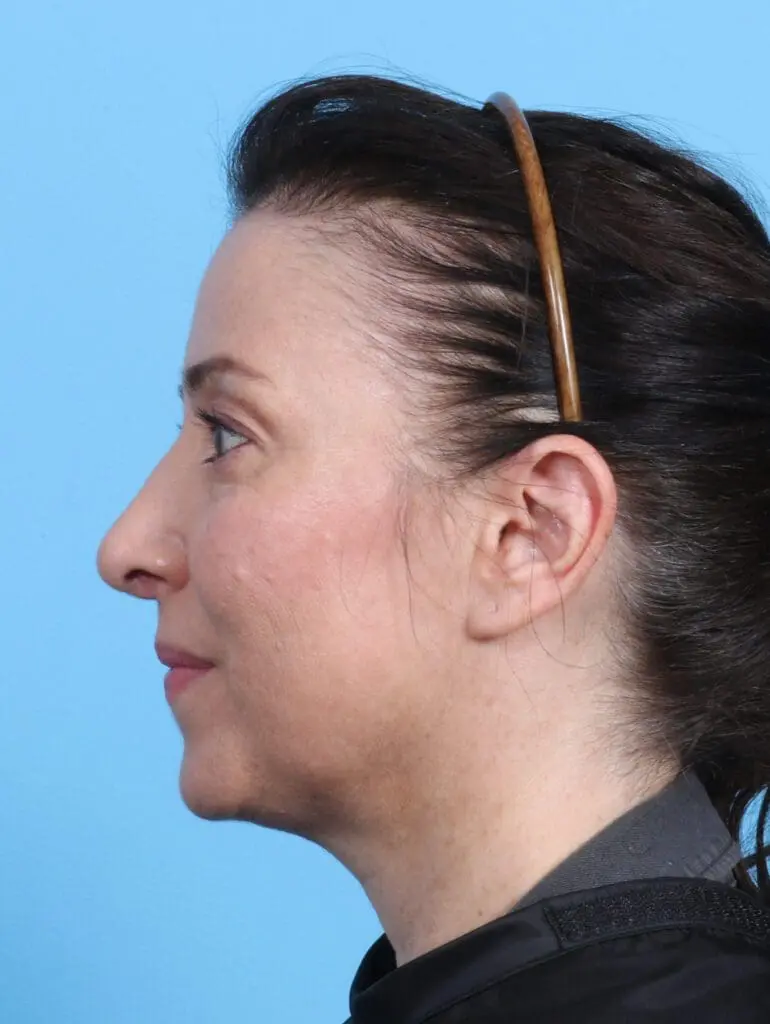 Rhinoplasty - Case 23600 - After