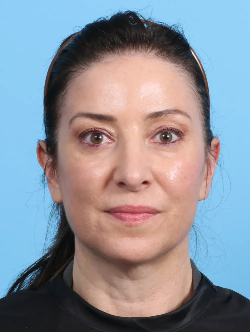 Rhinoplasty Patient Photo - Case 23600 - after view-1