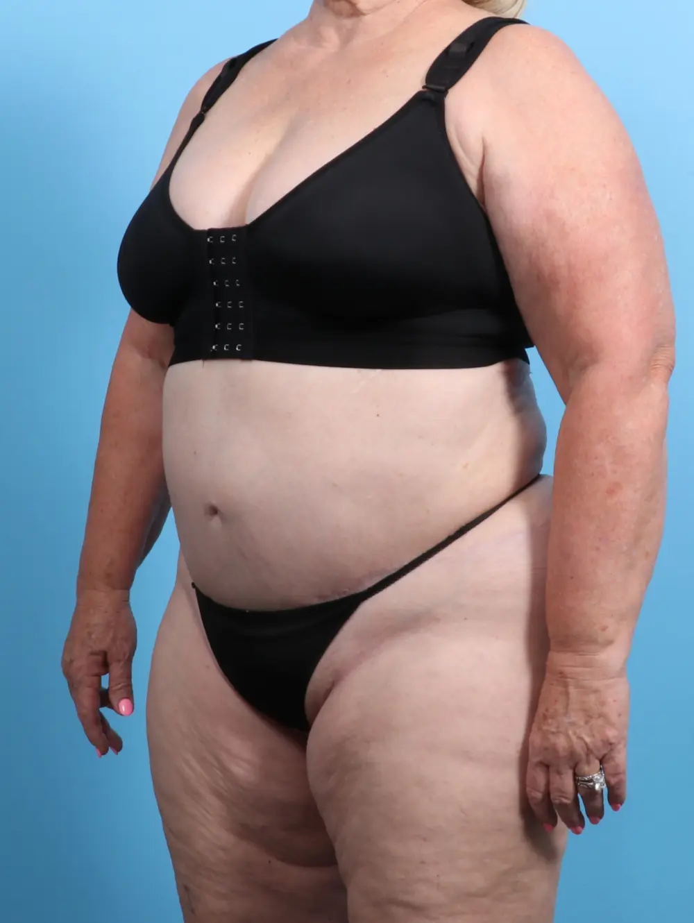 Tummy Tuck Patient Photo - Case 23616 - after view-1