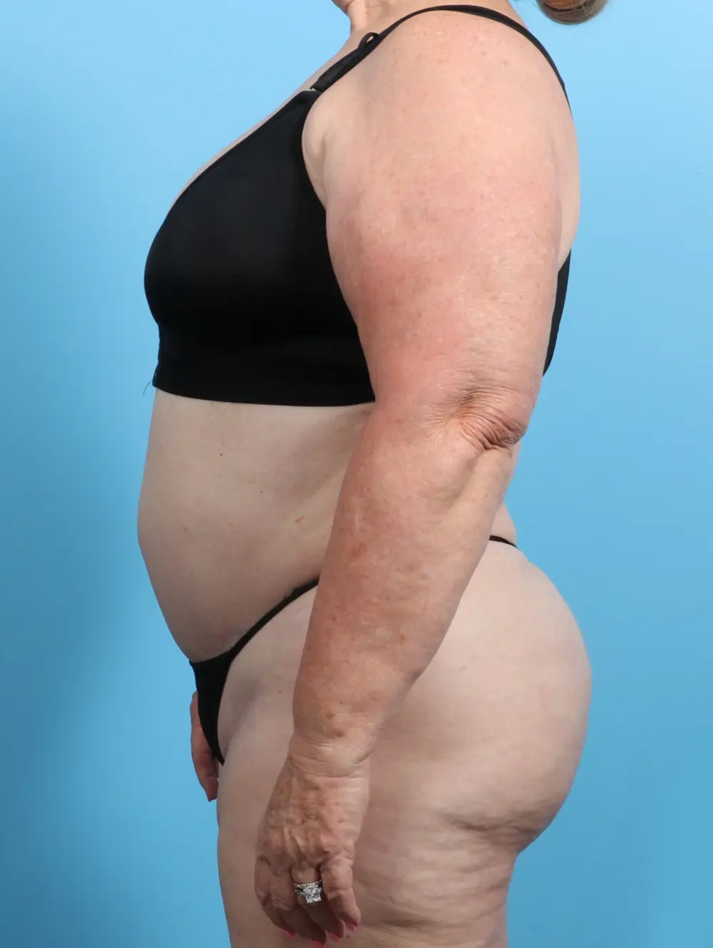 Tummy Tuck Patient Photo - Case 23616 - after view-2