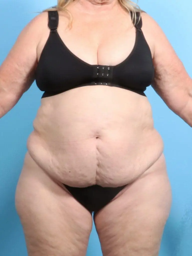 Tummy Tuck - Case 23616 - Before