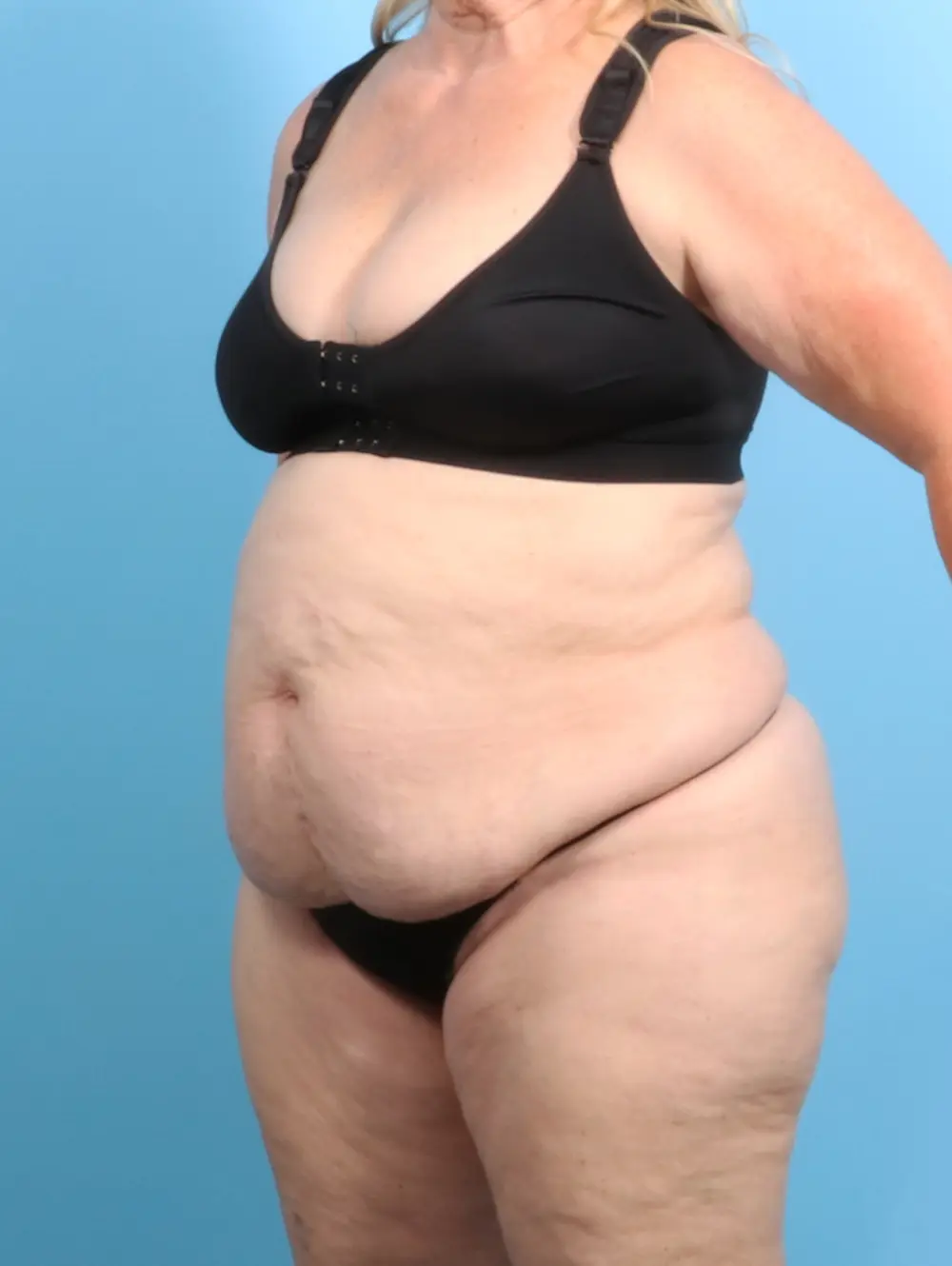 Tummy Tuck Patient Photo - Case 23616 - before view-1