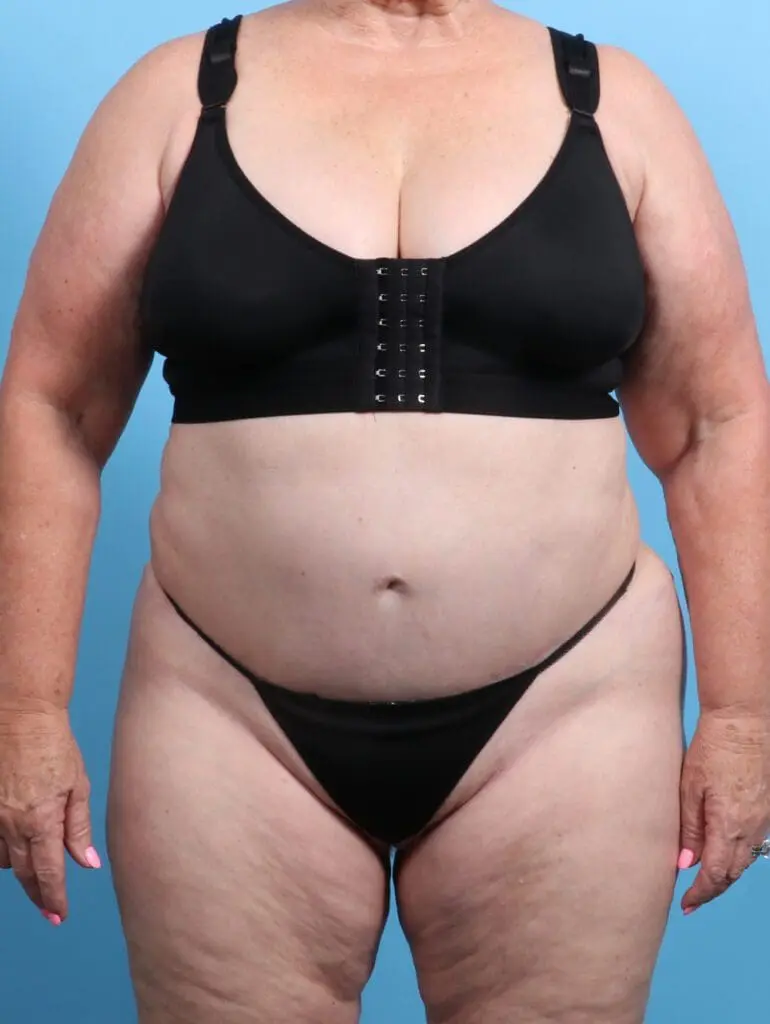 Tummy Tuck - Case 23616 - After