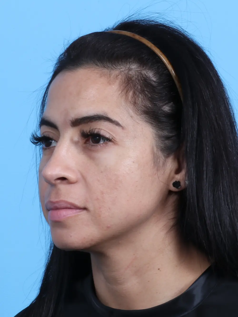 Rhinoplasty Patient Photo - Case 23669 - after view-2