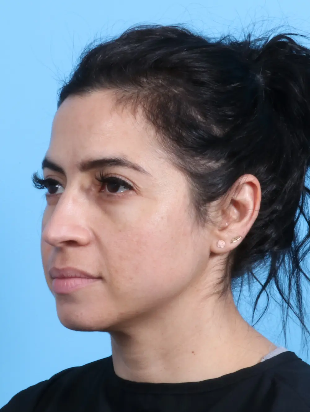 Rhinoplasty Patient Photo - Case 23669 - before view-2