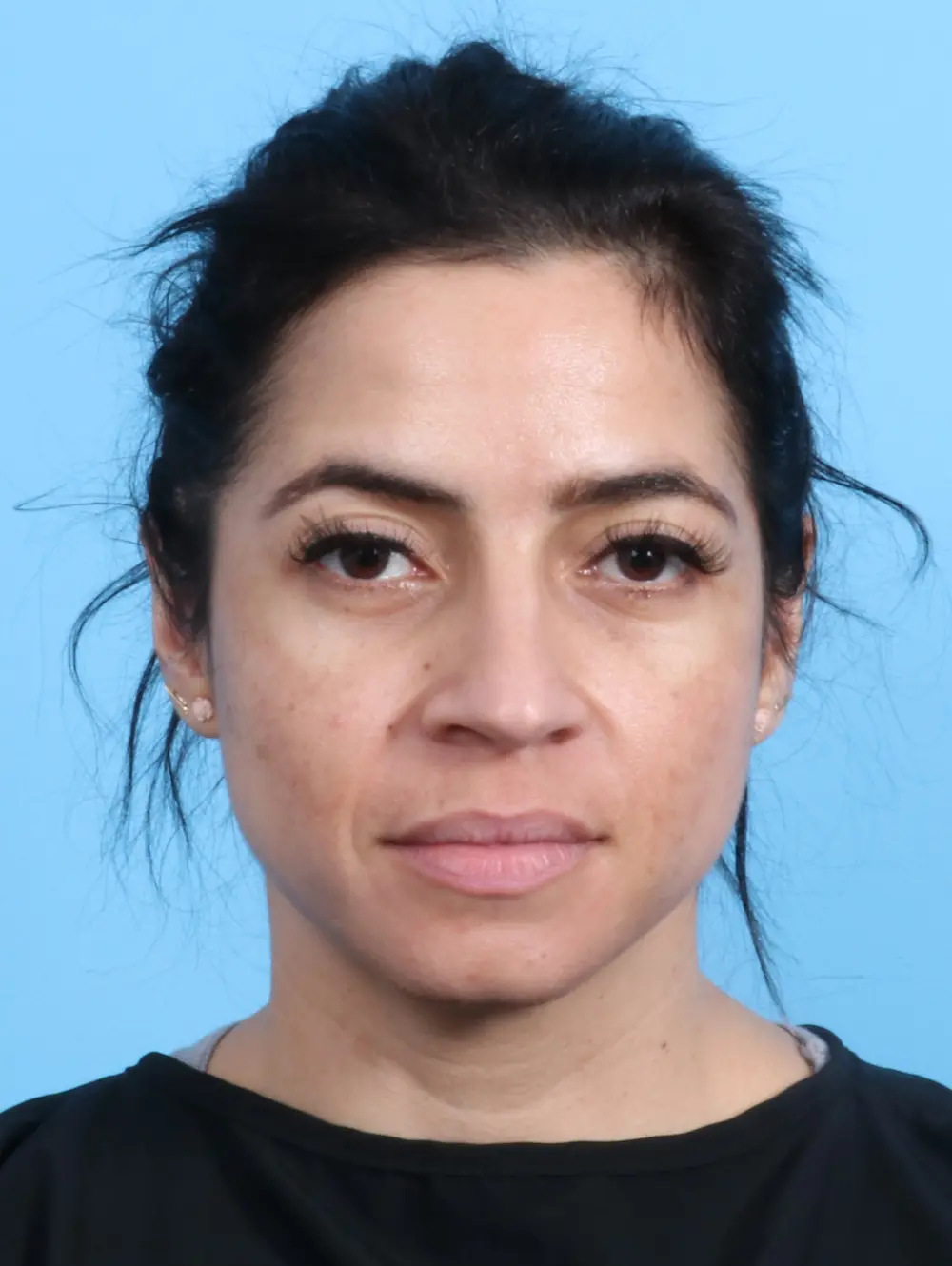 Rhinoplasty Patient Photo - Case 23669 - before view-1