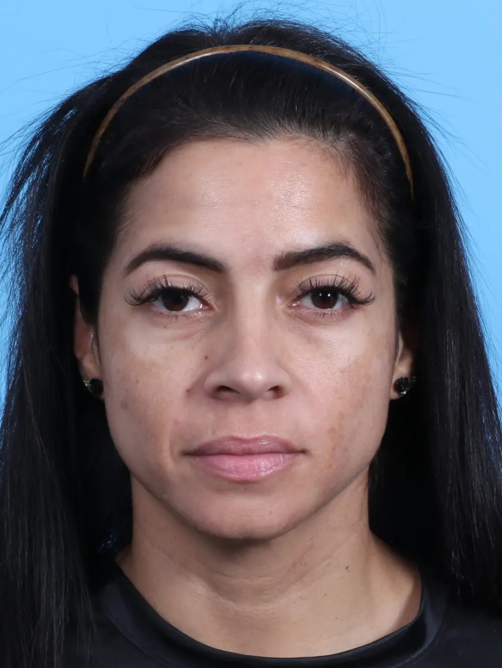 Rhinoplasty Patient Photo - Case 23669 - after view-1
