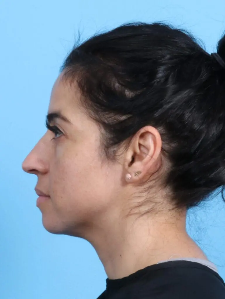 Rhinoplasty - Case 23669 - Before