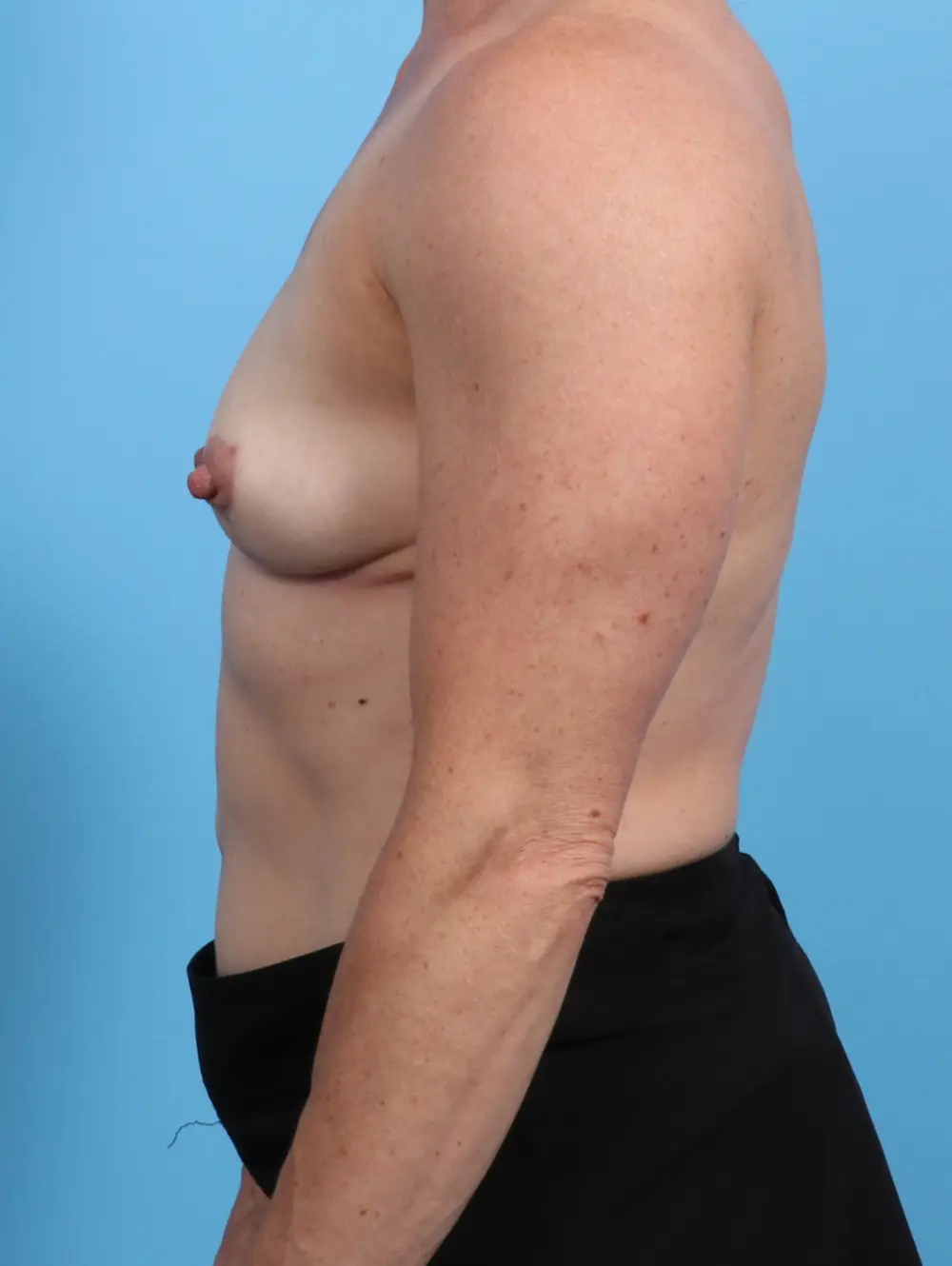 Breast Implant Removal Patient Photo - Case 23693 - after view-2