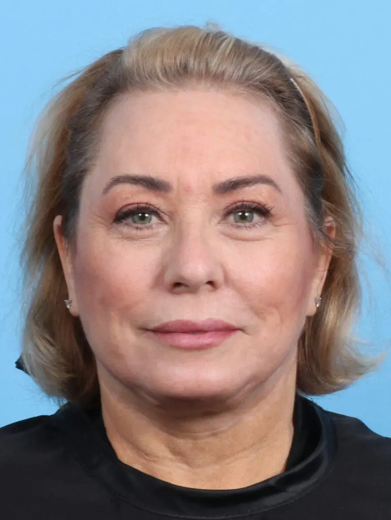 Eyelid Surgery - Case 23734 - After