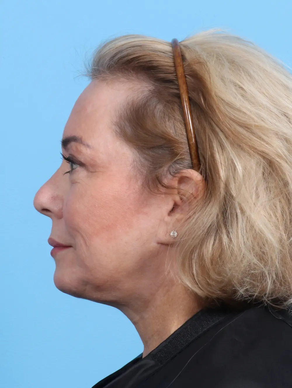 Eyelid Surgery Patient Photo - Case 23742 - after view-2