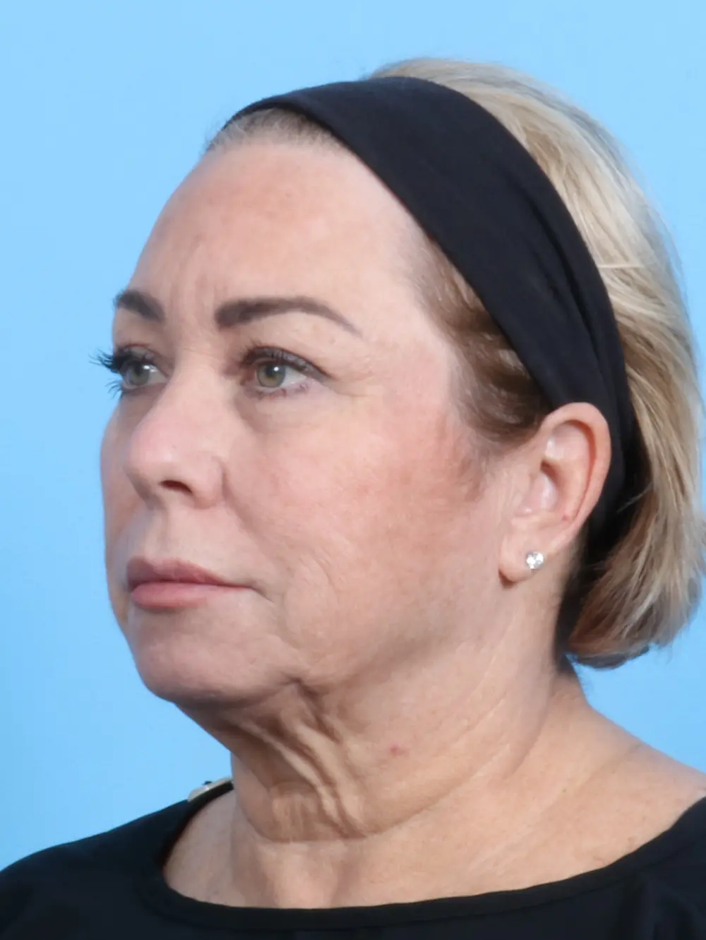 Eyelid Surgery Patient Photo - Case 23742 - before view-1