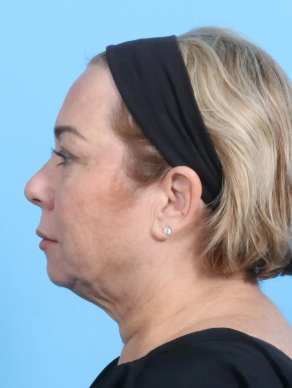 Eyelid Surgery Patient Photo - Case 23742 - before view-2